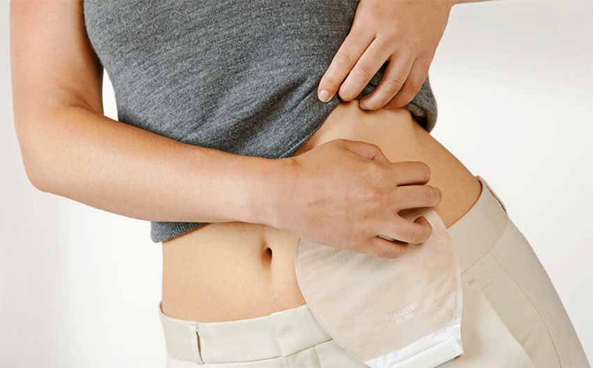 UFMA lança capacitação profissional com o tema Atenção à saúde da pessoa com estomia