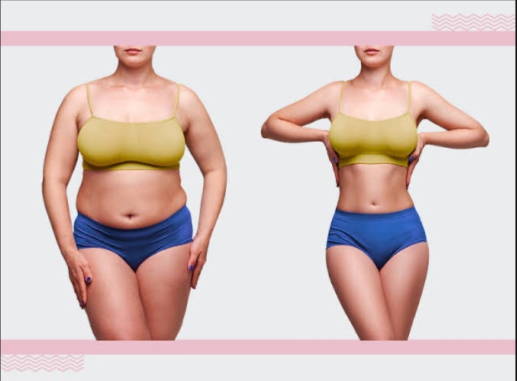 Tudo o que você precisa saber para decidir entre lipoaspiração e abdominoplastia e alcançar o abdômen dos seus sonhos